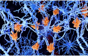 Λάδι κάνναβης και σκλήρυνση κατά πλάκας. Μπορεί να βοηθήσει, με ποιο τρόπο και ποιες είναι οι πιθανές παρενέργειες;